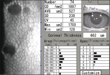 Diagnosis of Fuchs’ dystrophy