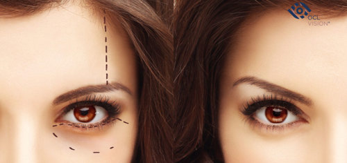 Blepharoplasty Surgery