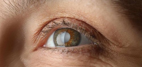 Living With Cataracts