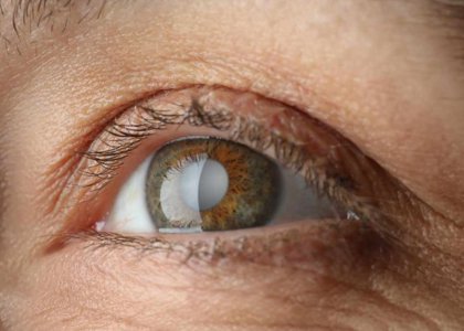 Living With Cataracts