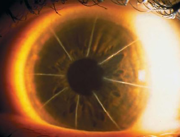 radial keratomy eye close up